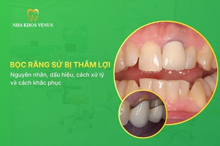 Bọc răng bị thâm lợi