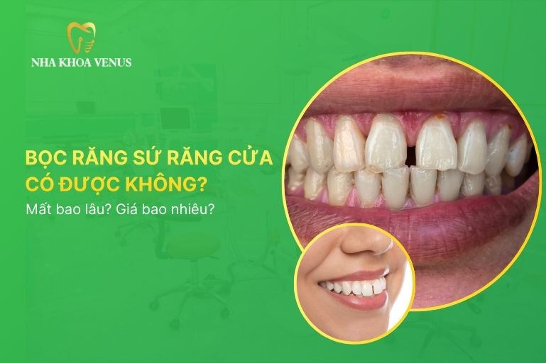 bọc răng sứ cho răng cửa mọc lệch