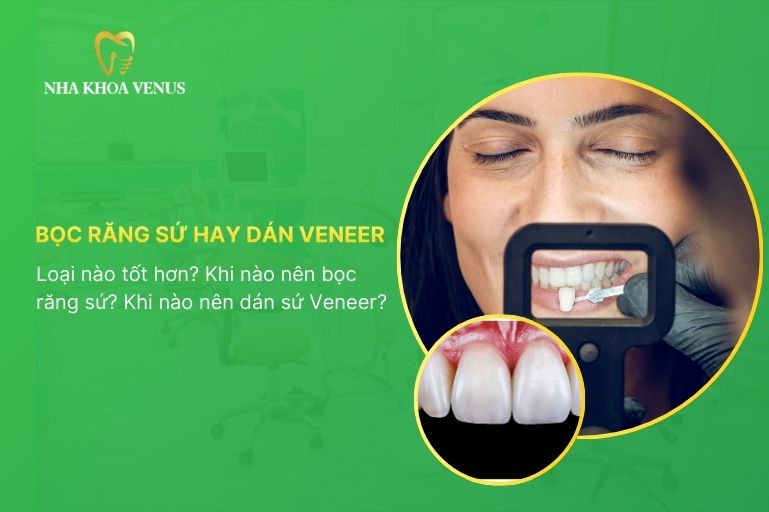 bọc răng sứ hay dán veneer