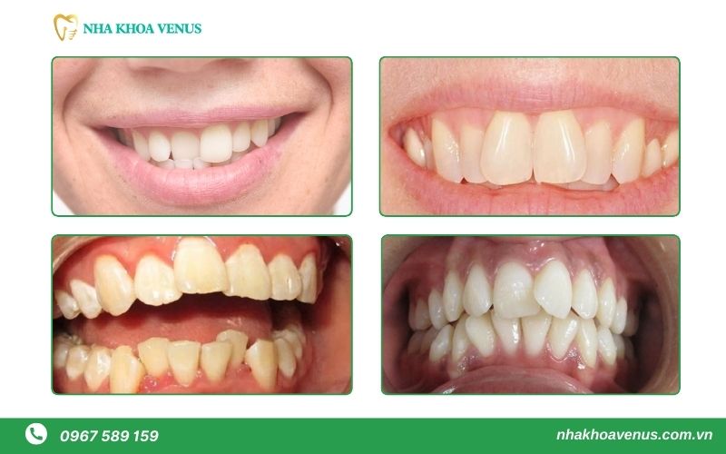 Bọc răng sứ cho răng cửa mọc lệch được không? Ai bọc được? Mất bao lâu? Giá bao nhiêu? 24 Các trường hợp lệch răng cửa có thể bọc răng sứ