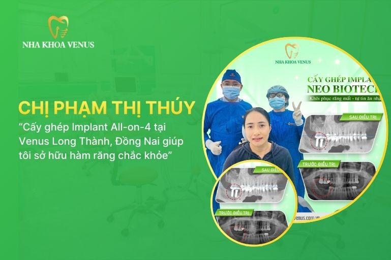 đánh giá của chị thúy về dịch vụ cấy ghép implant long thành, đồng nai tại nha khoa venus chi nhánh long thành, đồng nai