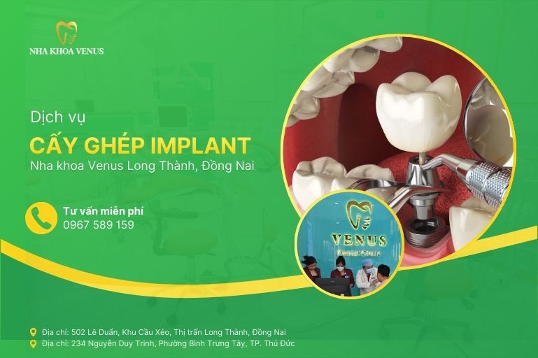 Dịch vụ cấy ghép implant Long Thành, Đồng Nai tại Nha khoa Venus chi nhánh Long Thành, Đồng Nai