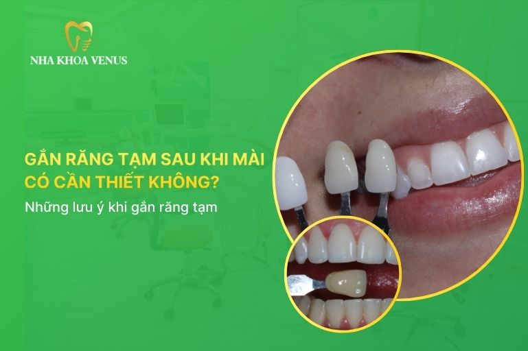 gắn răng tạm sau khi mài răng