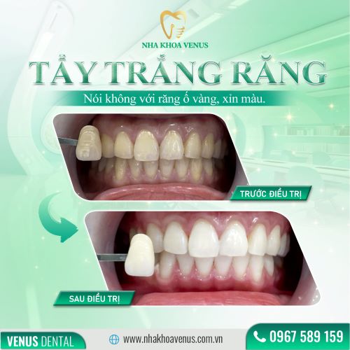 Địa chỉ cạo vôi răng uy tín ở Thủ Đức, răng sạch bóng chỉ với 200k tại Nha khoa Venus chi nhánh Thủ Đức, TPHCM 56 kết quả cạo vôi, tẩy trắng răng tại nha khoa venus
