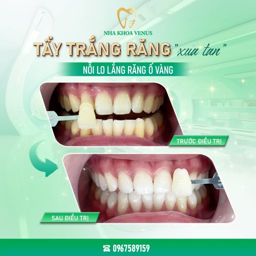 Địa chỉ cạo vôi răng uy tín ở Thủ Đức, răng sạch bóng chỉ với 200k tại Nha khoa Venus chi nhánh Thủ Đức, TPHCM 57 kết quả cạo vôi, tẩy trắng răng tại nha khoa venus