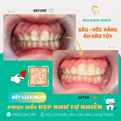 Địa chỉ cạo vôi răng uy tín ở Thủ Đức, răng sạch bóng chỉ với 200k tại Nha khoa Venus chi nhánh Thủ Đức, TPHCM 58 kết quả cạo vôi, tẩy trắng răng tại nha khoa venus