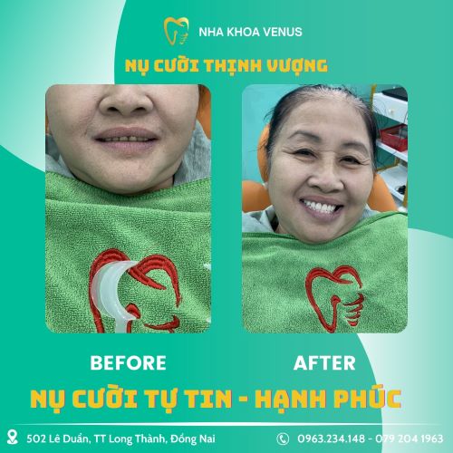 Địa chỉ cạo vôi răng uy tín ở Thủ Đức, răng sạch bóng chỉ với 200k tại Nha khoa Venus chi nhánh Thủ Đức, TPHCM 59 kết quả cạo vôi, tẩy trắng răng tại nha khoa venus