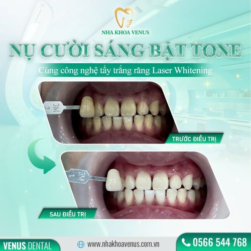 Địa chỉ cạo vôi răng uy tín ở Thủ Đức, răng sạch bóng chỉ với 200k tại Nha khoa Venus chi nhánh Thủ Đức, TPHCM 55 kết quả cạo vôi, tẩy trắng răng tại nha khoa venus