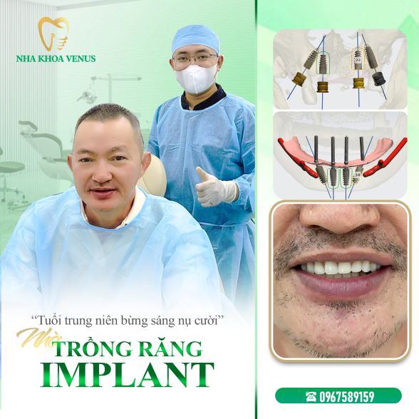 Trụ Implant Dentium là gì? Xuất xứ, cấu tạo và bảng giá trụ Dentium Implant 2025 36 Kết quả cấy ghép Implant tại Nha khoa Venus