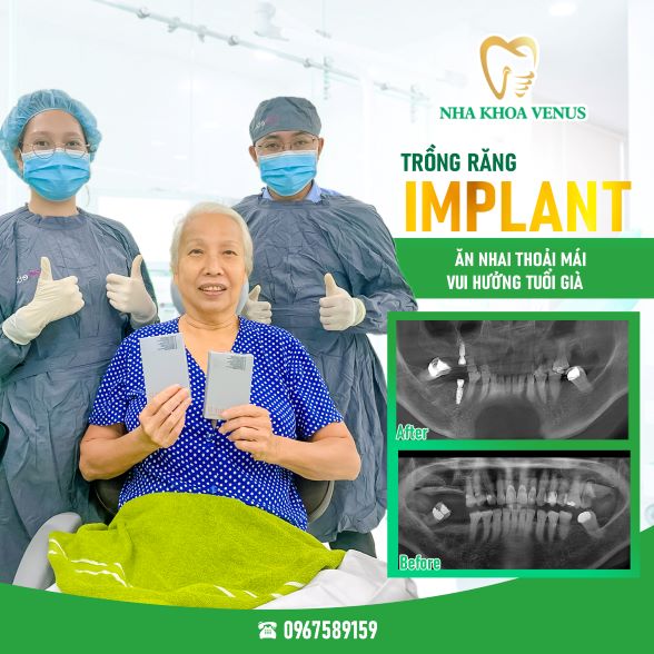 Trụ Implant Dentium là gì? Xuất xứ, cấu tạo và bảng giá trụ Dentium Implant 2025 35 Kết quả cấy ghép Implant tại Nha khoa Venus