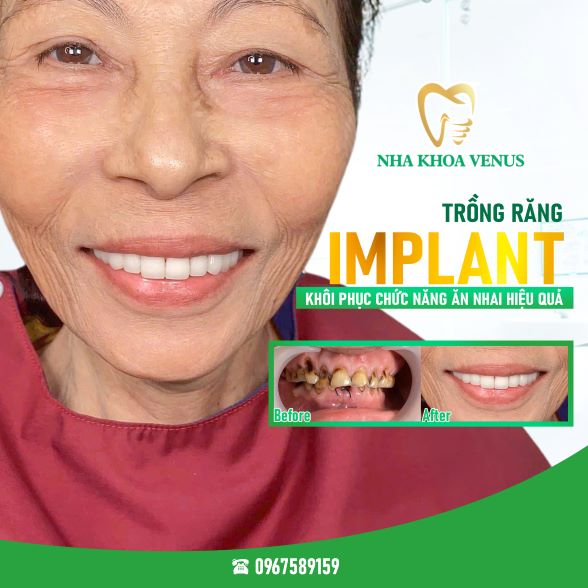 Trụ Implant Dentium là gì? Xuất xứ, cấu tạo và bảng giá trụ Dentium Implant 2025 34 Kết quả cấy ghép Implant tại Nha khoa Venus