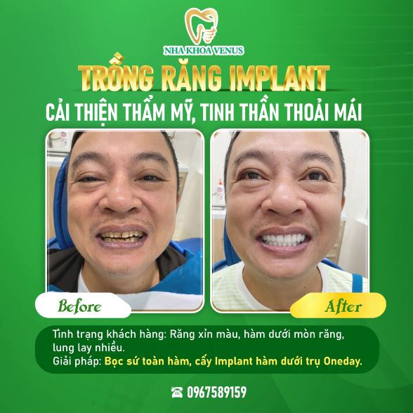 Trụ Implant Dentium là gì? Xuất xứ, cấu tạo và bảng giá trụ Dentium Implant 2025 33 Kết quả cấy ghép Implant tại Nha khoa Venus