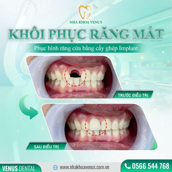Trụ Implant Dentium là gì? Xuất xứ, cấu tạo và bảng giá trụ Dentium Implant 2025 32 Kết quả cấy ghép Implant tại Nha khoa Venus