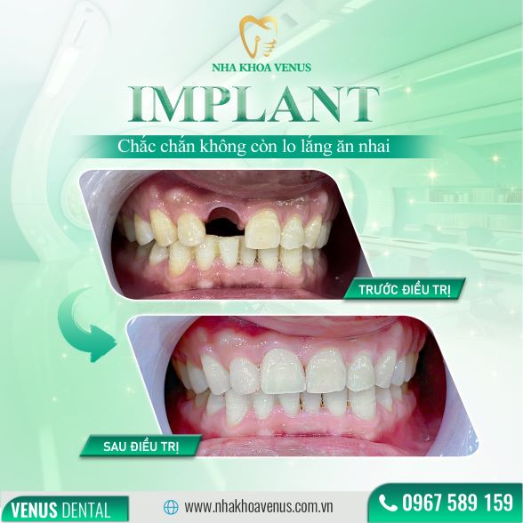 Trụ Implant Dentium là gì? Xuất xứ, cấu tạo và bảng giá trụ Dentium Implant 2025 31 Kết quả cấy ghép Implant tại Nha khoa Venus