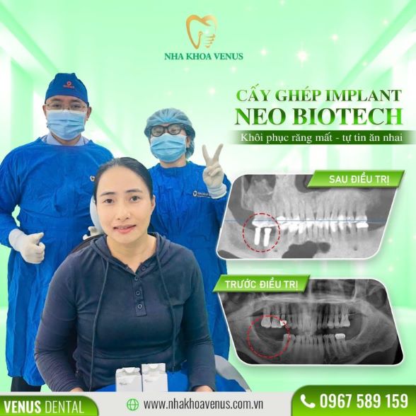 Trụ Implant Dentium là gì? Xuất xứ, cấu tạo và bảng giá trụ Dentium Implant 2025 25 Kết quả cấy ghép Implant tại Nha khoa Venus