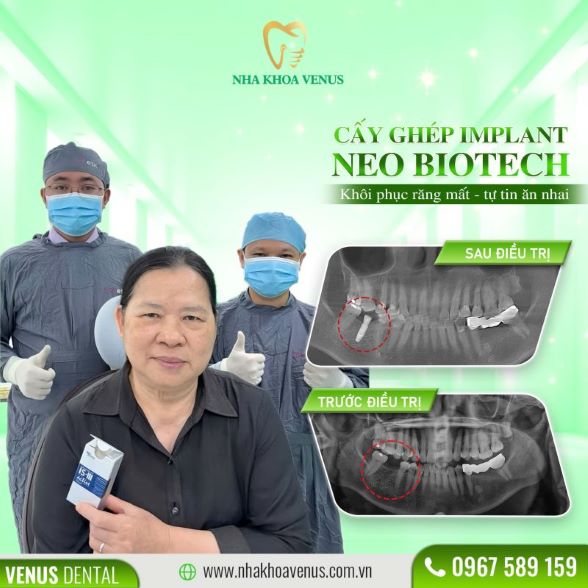 Trụ Implant Dentium là gì? Xuất xứ, cấu tạo và bảng giá trụ Dentium Implant 2025 24 Kết quả cấy ghép Implant tại Nha khoa Venus