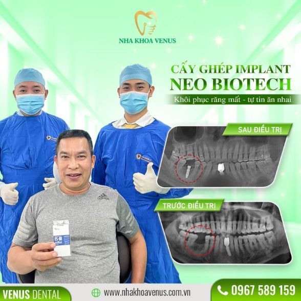 Trụ Implant Dentium là gì? Xuất xứ, cấu tạo và bảng giá trụ Dentium Implant 2025 23 Kết quả cấy ghép Implant tại Nha khoa Venus