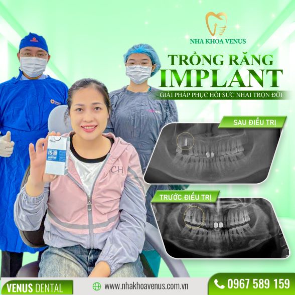 Trụ Implant Dentium là gì? Xuất xứ, cấu tạo và bảng giá trụ Dentium Implant 2025 30 Kết quả cấy ghép Implant tại Nha khoa Venus