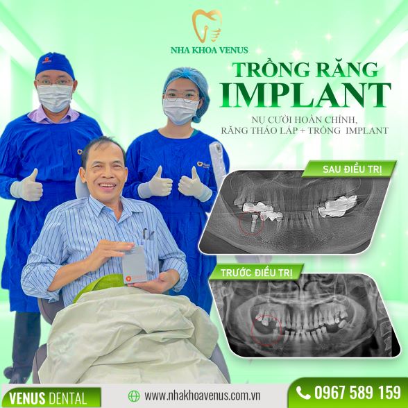 Trụ Implant Dentium là gì? Xuất xứ, cấu tạo và bảng giá trụ Dentium Implant 2025 29 Kết quả cấy ghép Implant tại Nha khoa Venus