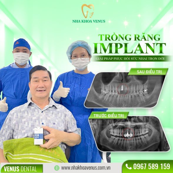 Trụ Implant Dentium là gì? Xuất xứ, cấu tạo và bảng giá trụ Dentium Implant 2025 28 Kết quả cấy ghép Implant tại Nha khoa Venus
