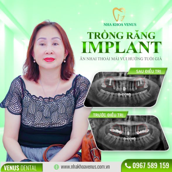 Trụ Implant Dentium là gì? Xuất xứ, cấu tạo và bảng giá trụ Dentium Implant 2025 27 Kết quả cấy ghép Implant tại Nha khoa Venus