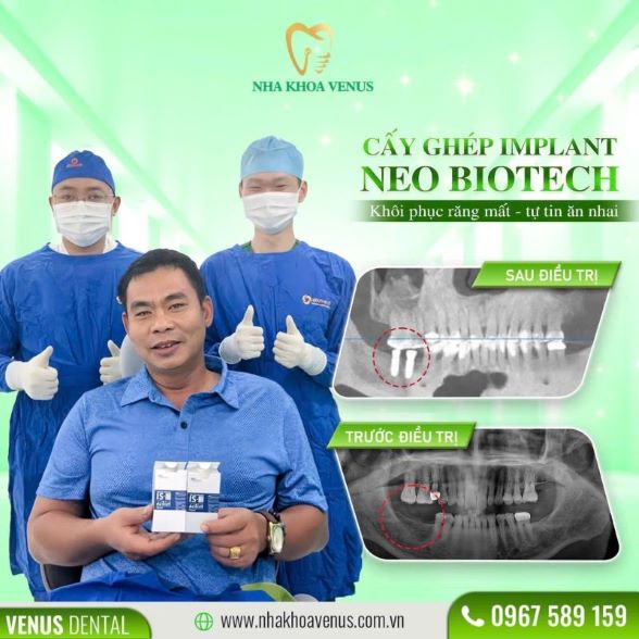 Trụ Implant Dentium là gì? Xuất xứ, cấu tạo và bảng giá trụ Dentium Implant 2025 26 Kết quả cấy ghép Implant tại Nha khoa Venus