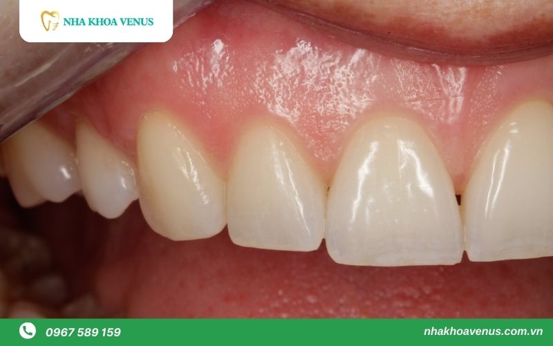 12 Tiêu chí đánh giá của 1 hàm răng đẹp tiêu chuẩn như người mẫu 25 Nướu khỏe mạnh
