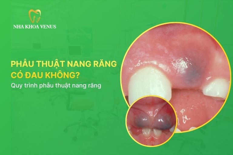 Phẫu thuật nang răng có đau không
