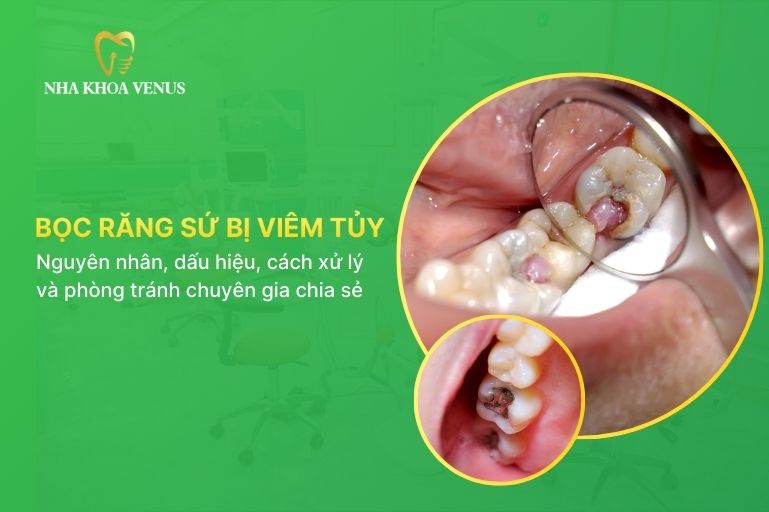 răng bọc sứ bị viêm tuỷ