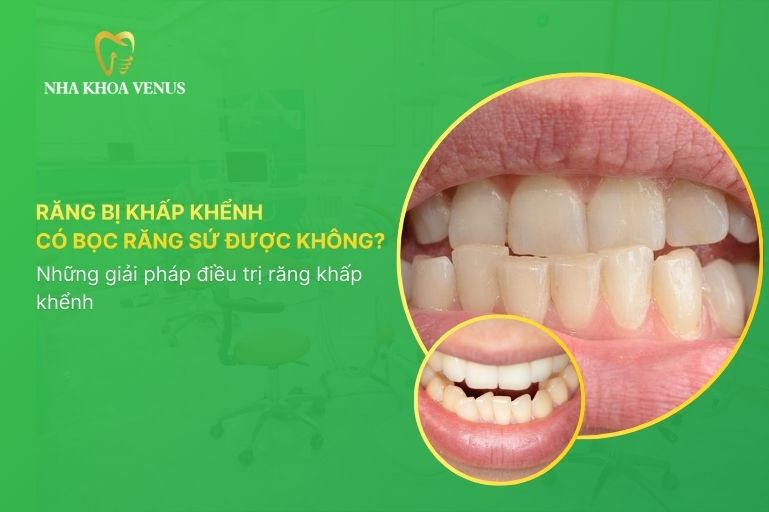 Răng khấp khểnh có nên bọc sứ không