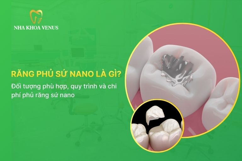 răng phủ sứ nano là gì