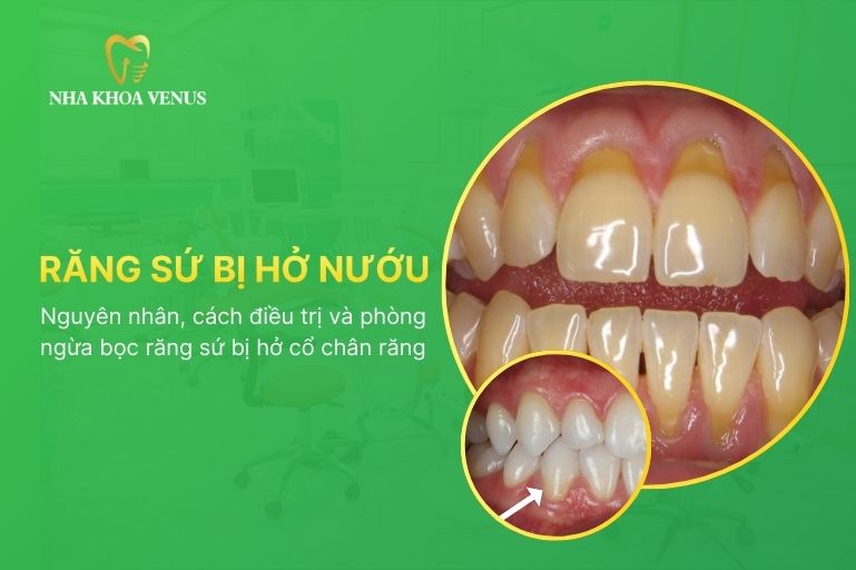 răng sứ bị hở nướu