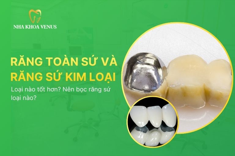 răng toàn sứ và răng sứ kim loại