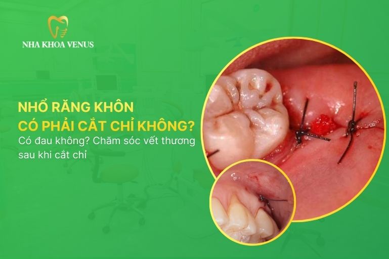 Nhổ răng khôn xong có phải đi cắt chỉ không? Có đau không? Chăm sóc vết thương sau khi cắt chỉ