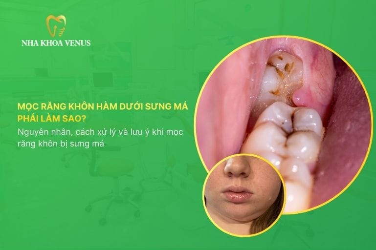 Mọc răng khôn hàm dưới sưng má phải làm sao Nguyên nhân, cách xử lý và lưu ý khi mọc răng khôn bị sưng má