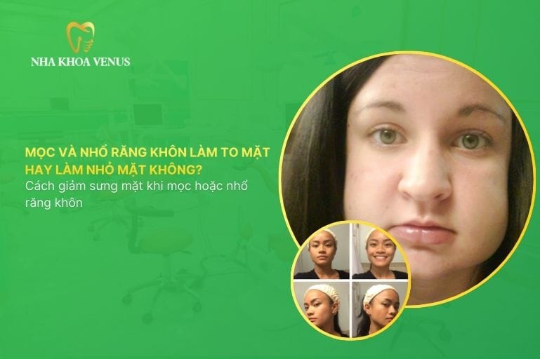 Mọc và nhổ răng khôn làm to mặt hay làm nhỏ mặt không Cách giảm sưng mặt khi mọc hoặc nhổ răng khôn