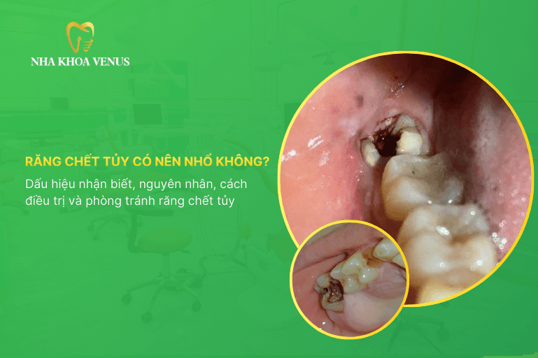 Răng chết tủy có nên nhổ không? Dấu hiệu nhận biết, nguyên nhân, cách điều trị và phòng tránh răng chết tủy