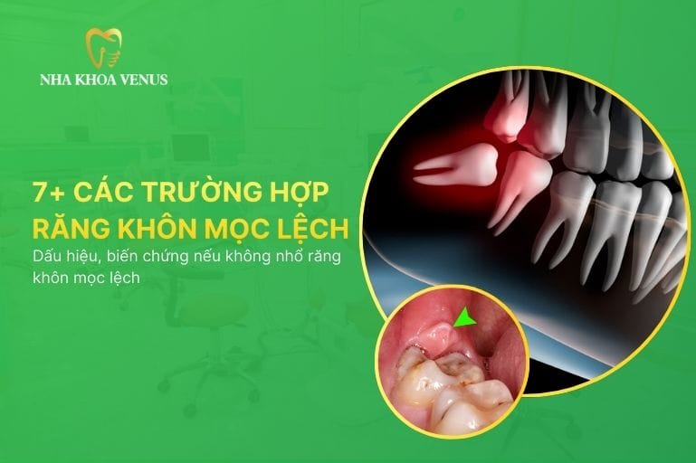 các trường hợp răng khôn mọc lệch