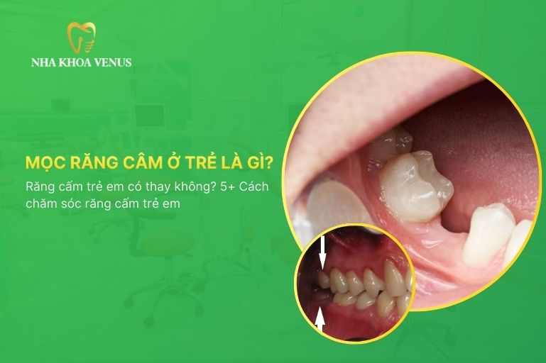 Giải đáp răng cấm trẻ em có thay không