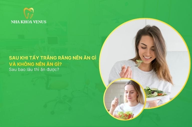 Sau khi tẩy trắng răng nên ăn gì và không nên ăn gì Sau bao lâu thì ăn được