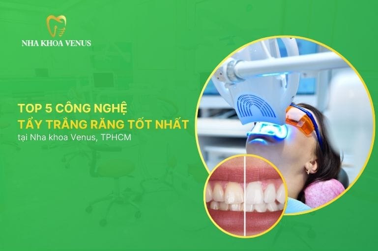 Top 5 công nghệ tẩy trắng răng tốt nhất hiện nay 2025 tại TPHCM