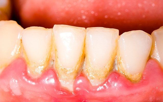 Biến chứng nguy hiểm nếu không điều trị viêm nha chu kịp thời