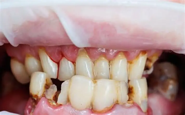 Những nguyên nhân phổ biến gây ra bệnh viêm nha chu