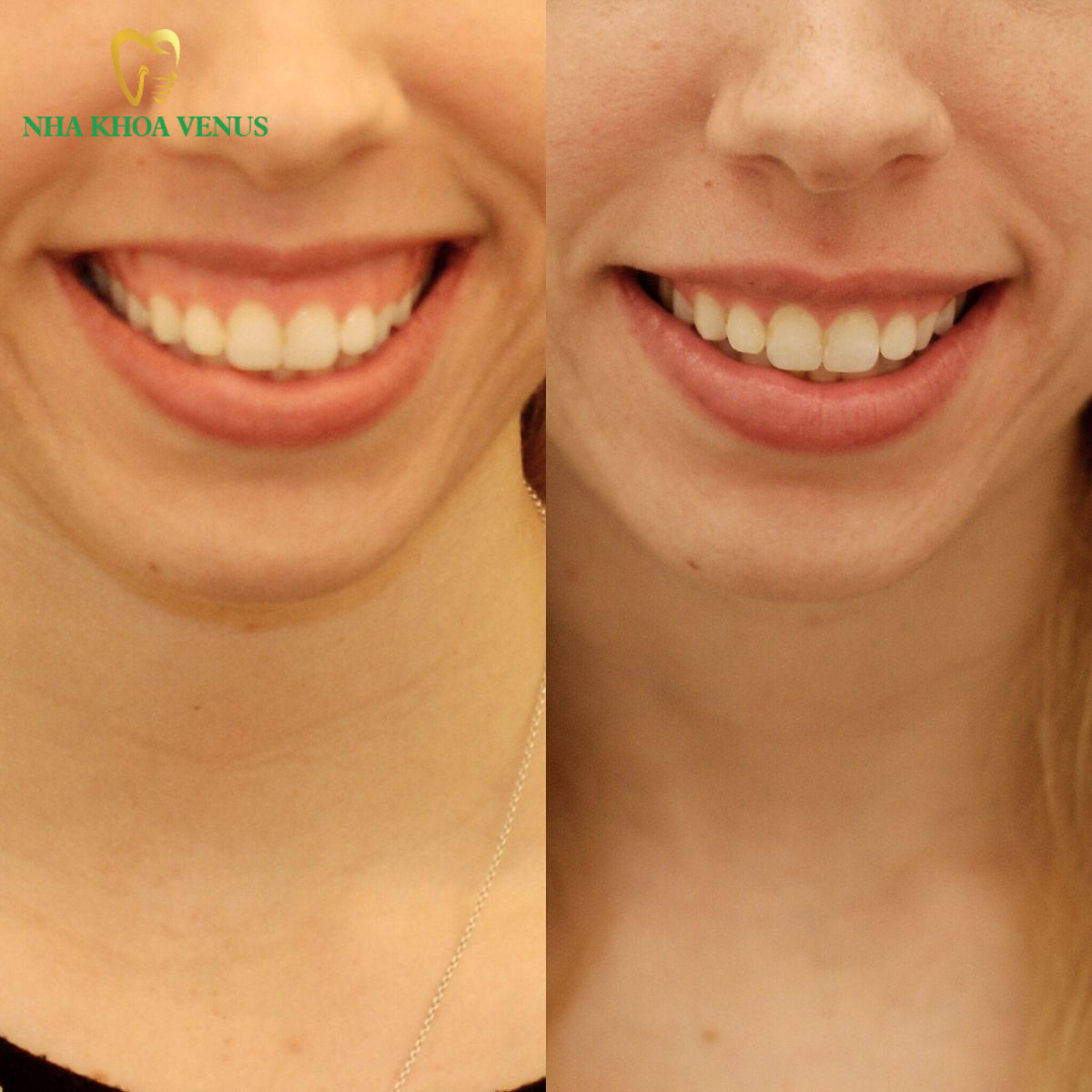 Dịch vụ điều trị cười hở lợi Đồng Nai uy tín giá từ 500.000đ 12 Dịch vụ điều trị cười hở