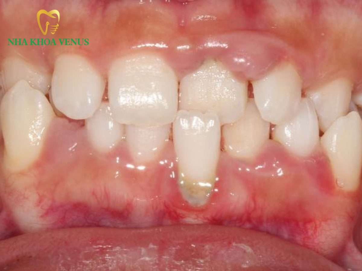 Điều trị tụt nướu răng tại Đồng Nai