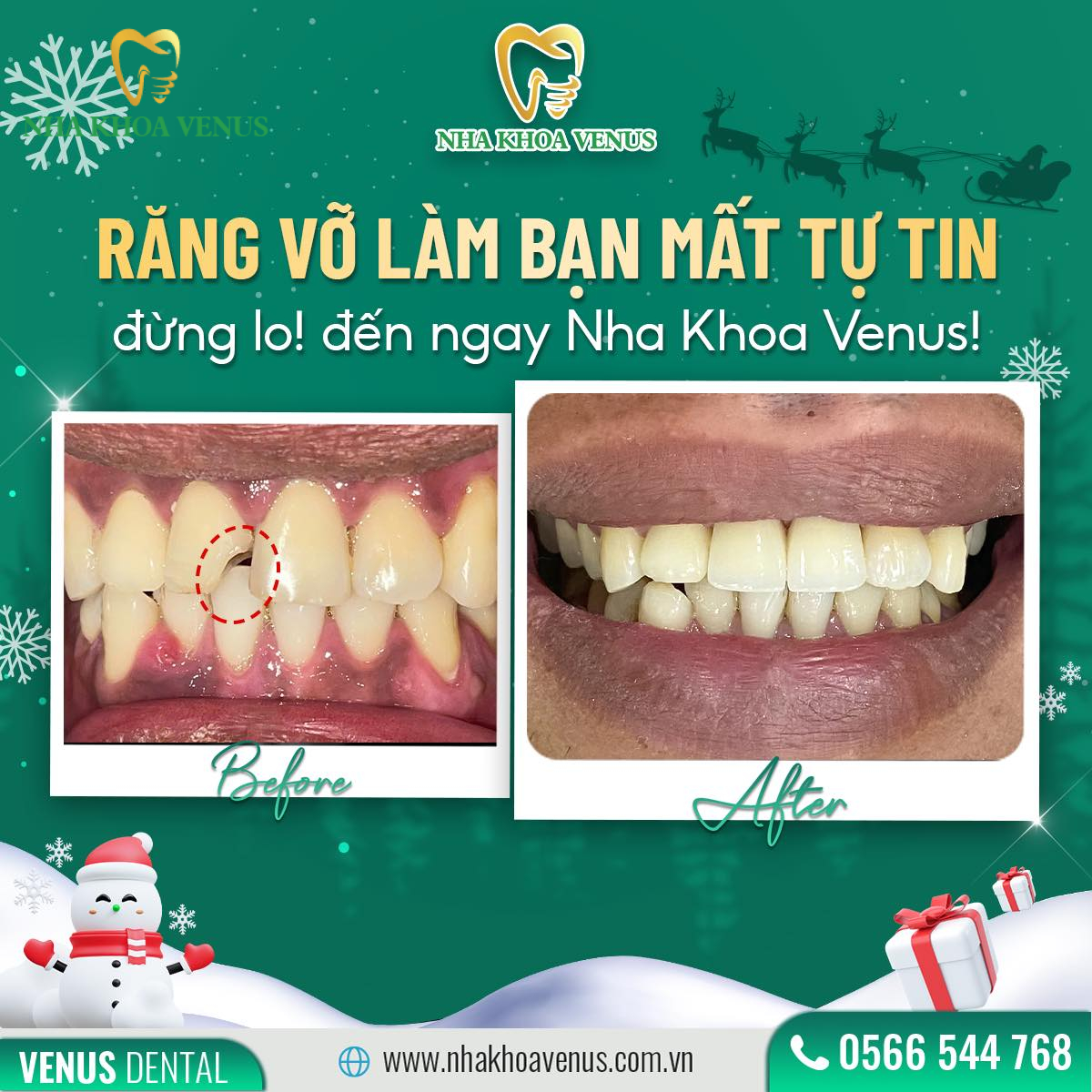Dịch vụ phục hình răng tháo lắp Long Thành, Đồng Nai uy tín giá từ 250.000đ tại Nha Khoa Venus 16 Kết quả và đánh giá khách hàng sau khi phục hình răng tháo lắp tại Nha khoa Venus