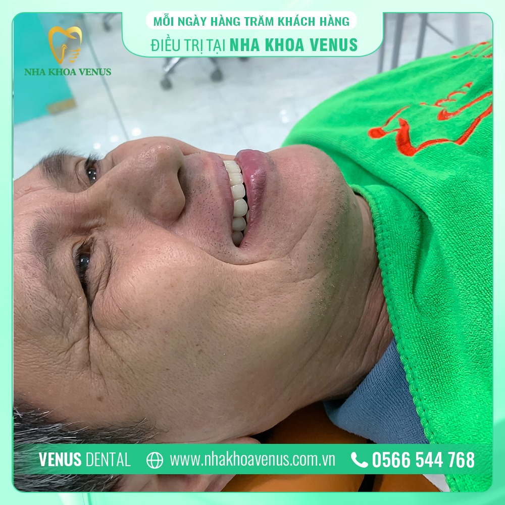 Dịch vụ điều trị cười hở lợi Đồng Nai uy tín giá từ 500.000đ 15 Phương pháp điều trị cười hở lợi tại Nha Khoa Venus