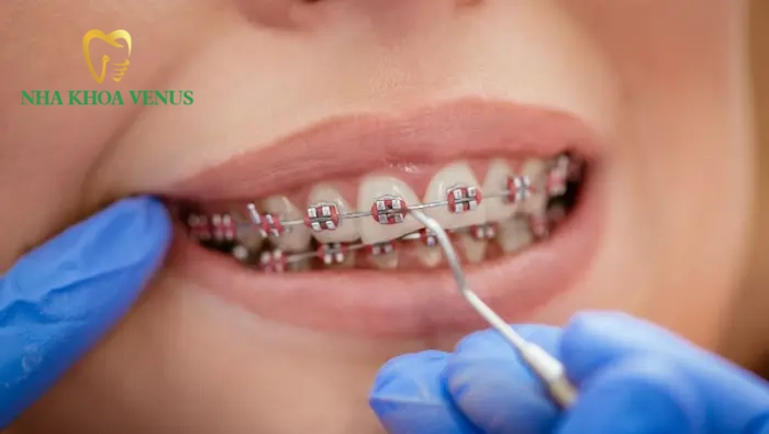 Chi phí làm răng tiết kiệm cho người bận rộn 4 Dịch vụ niềng răng