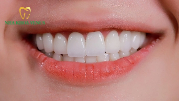 Nha khoa Venus 136 Máng hướng dẫn phẫu thuật Implant 3D giúp định vị trụ chính xác tuyệt đối