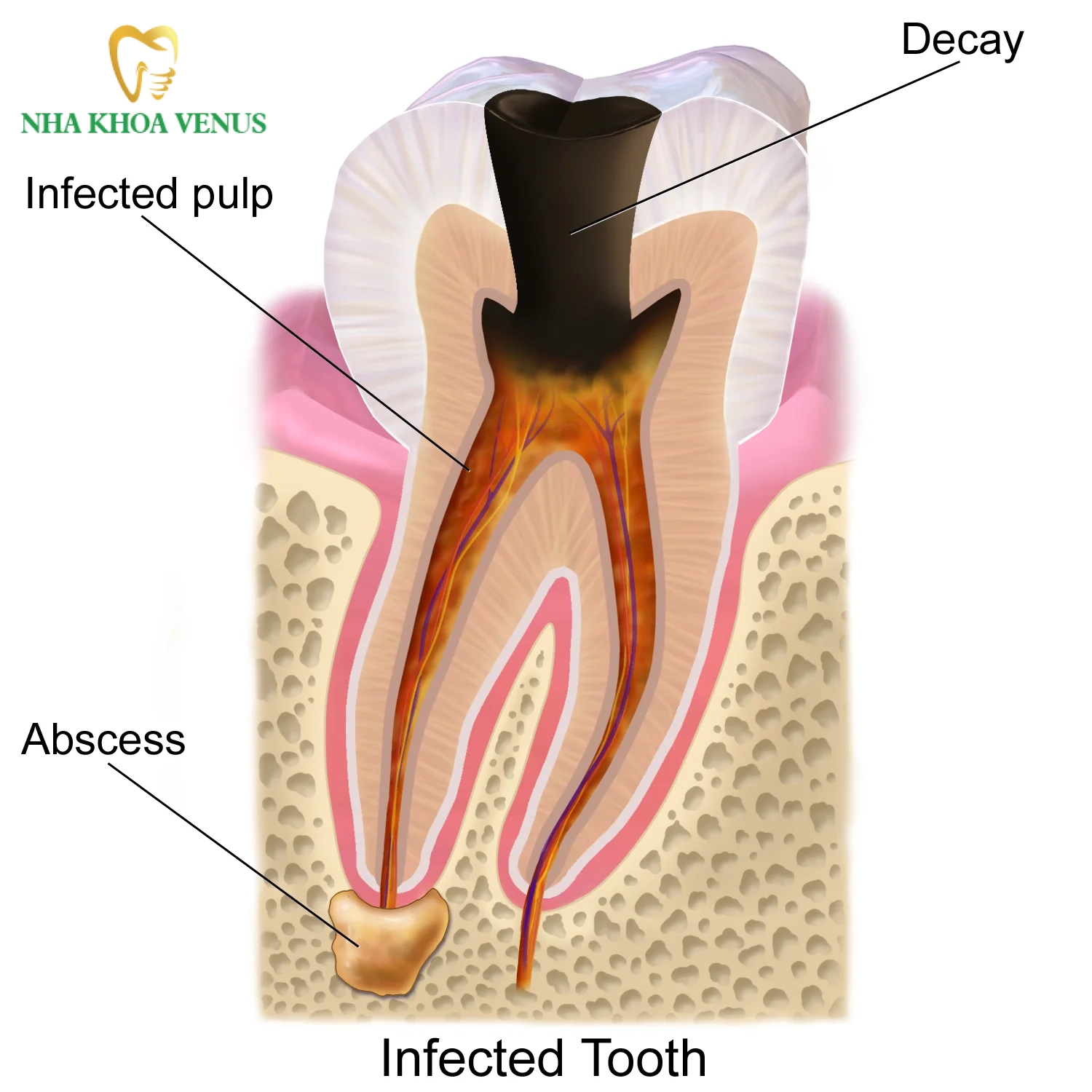 Răng bị vỡ dọc có giữ được không? 7 các giai đoạn tổn thương sâu răng làm mỏng thành răng dẫn đến nứt vỡ dọc